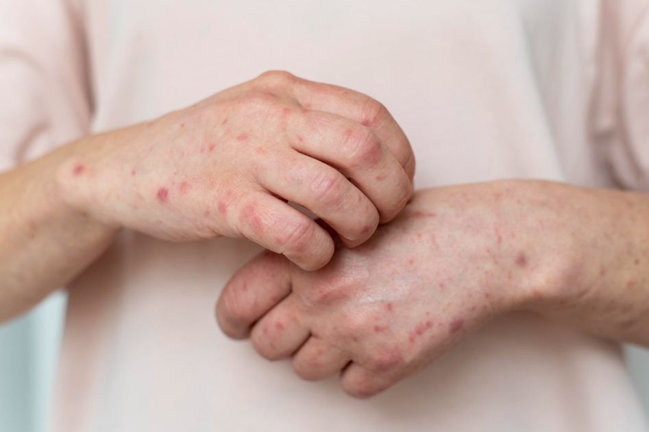 Araraquara inicia vacinação contra a Monkeypox; veja público-alvo