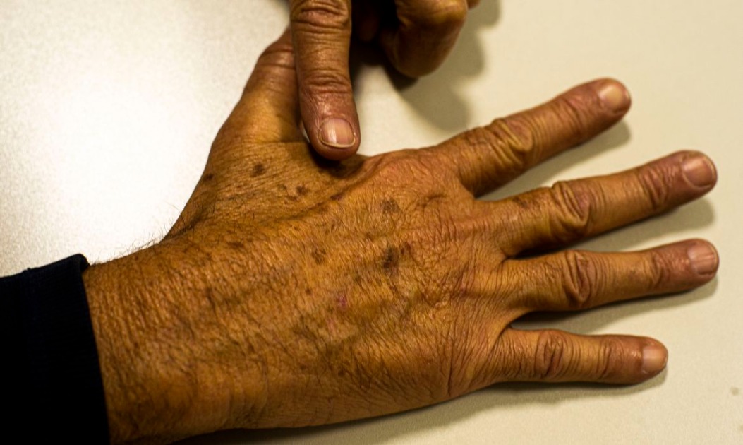 Mês de conscientização ao melanoma: médica alerta para cuidados com a doença